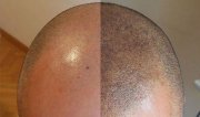 hair micropigmentation